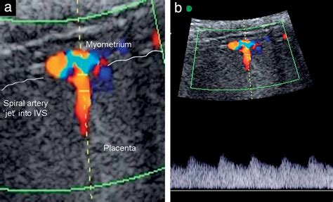 Measurement Of Spiral Artery Jets General Principles And Differences