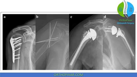 Proximal Humerus Fracture Easy Explained Orthofixar