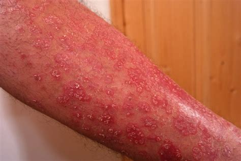 Relief For Psoriasis And Shingles Sufferers Chaffree