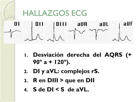 Bloqueo De Rama Ppt