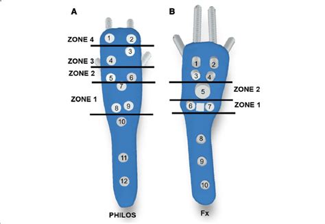 Numbering and zoning of screws and blade holes on PHILOS plate (a) and ...