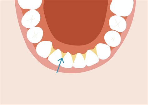 歯垢（プラーク）とは｜歯石との違いは？歯垢がつきやすい人や簡単な取り方｜wakanote