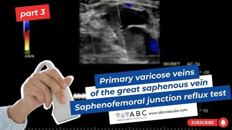 Part 3 Primary Varicose Veins Of The Great Saphenous Vein