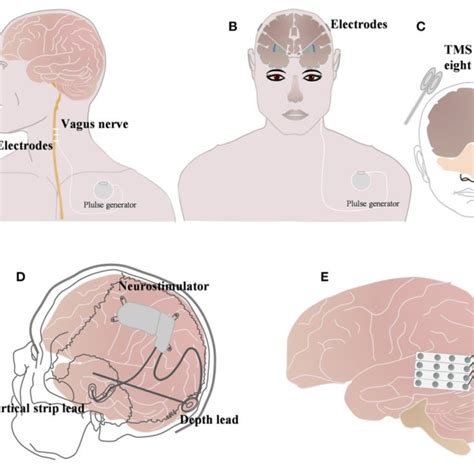 Brief Schematic Diagram Of Three Neuromodulation Techniques Commonly