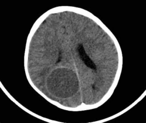 Hydatid Cyst In The Brain Medizzy Journal