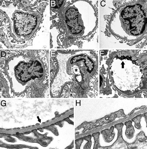 Transmission Electron Micrographs Of Representative Glomerular