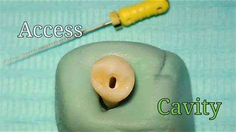 Access Cavity Preparation - Mandibular First Premolar - YouTube