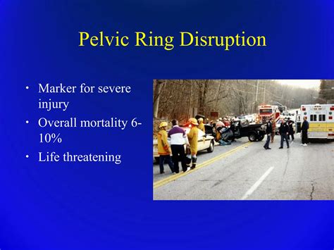 Trauma pelvic fracture ortho prespective | PPT