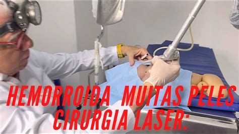 Hemorroidas C Muitas Peles Tratadas Laser C Anestesia Local Seda O