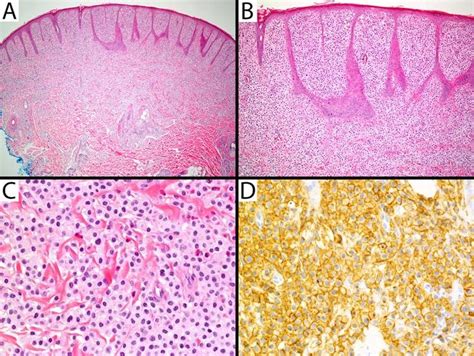 Cutaneous mastocytoma. A) Hematoxylin and eosin (HE, 40X) demonstrating ...