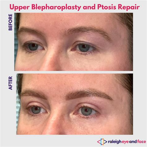 Ptosis Repair Gallery Ptosis Repair Specialist Raleigh — Raleigh Eye