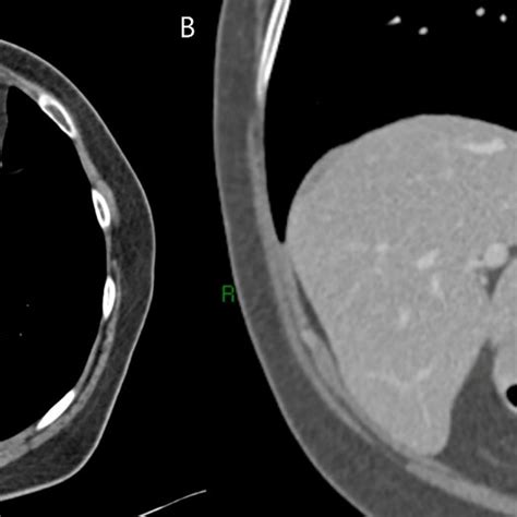 A Ct Scan With Axial B And Coronal Reconstruction C Images Showing