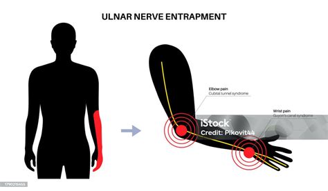 Ulnar Nerve Entrapment Stock Illustration Download Image Now Adult Anatomy Arm Istock