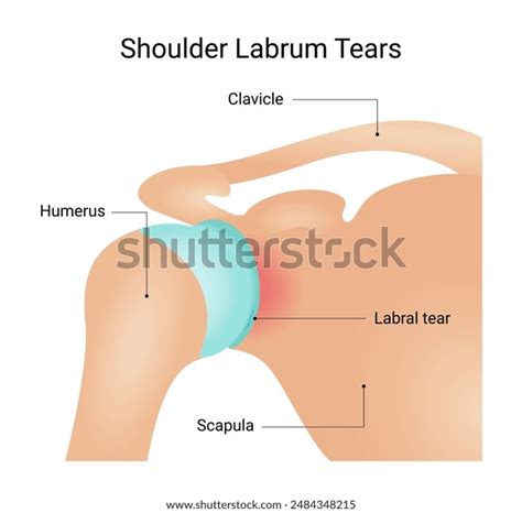 Symptoms Shoulder Labrum Tear Stock Vector (Royalty Free) 2484348215 ...