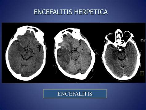 Encefalitis herpética qué es Síntomas tratamiento y más