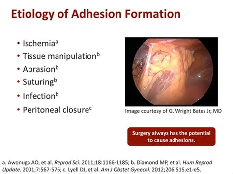 A Practical Guide To The Prevention Of Surgical Adhesions Transcript