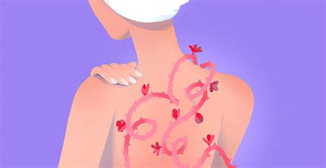 Прыщи на теле: что делать и как избавиться