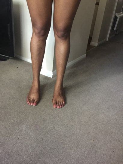 Fat Calves Skinny Body