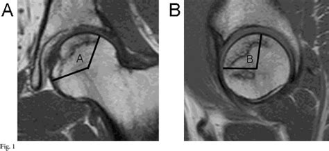 Figure 1 From Prediction Of Collapse In Femoral Head Osteonecrosis A