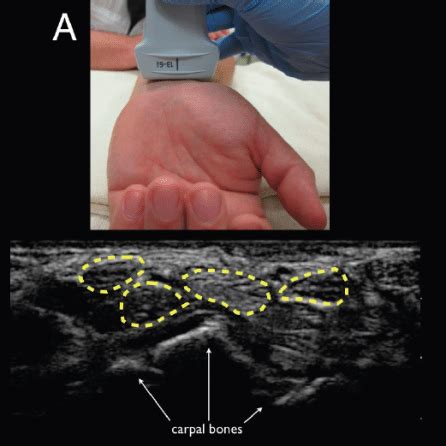 Emergency Ultrasound Identification of a Cornual Ectopic Pregnancy - The Western Journal of ...