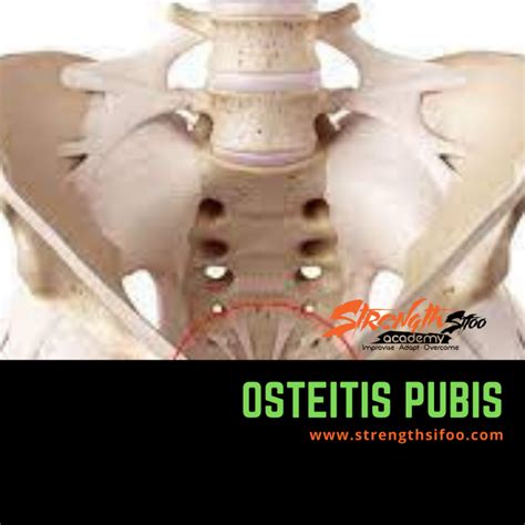 Osteitis Pubis