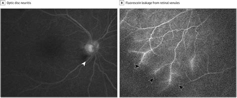 Coronavirus Disease 2019associated Ocular Neuropathy With Panuveitis