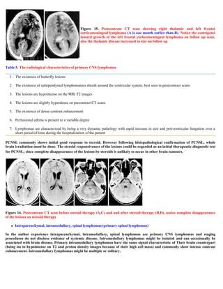 Case Record Epidural Secondary Cns Lymphoma Pdf