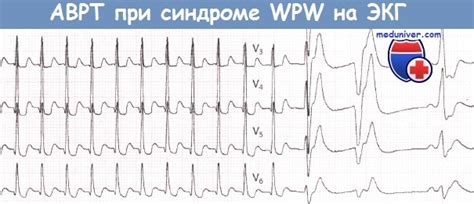 Нарушения ритма сердца при синдроме WPW (Вольфа-Паркинсона-Уайта)