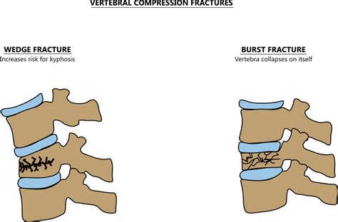 Vertebral compression fracture