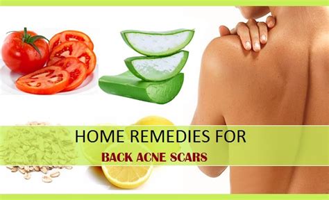 Home Remedies for Back Acne Scars and Marks