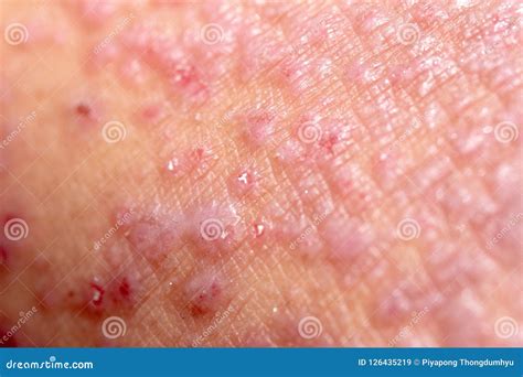 Atopic Dermatitis Ad Also Known As Atopic Eczema Is A Type Of