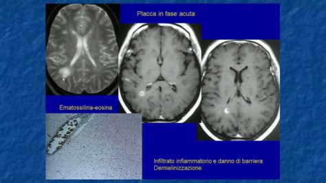 Sostanza Bianca Periventricolare Funzione E Patologie Actualizado