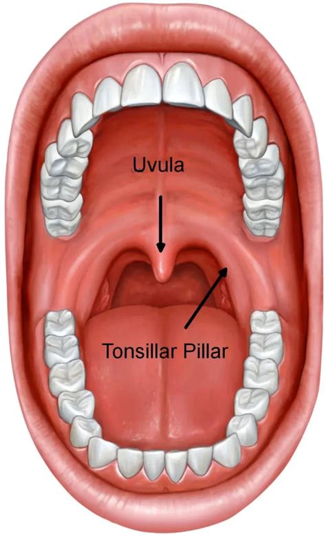 Tonsillitis Grading