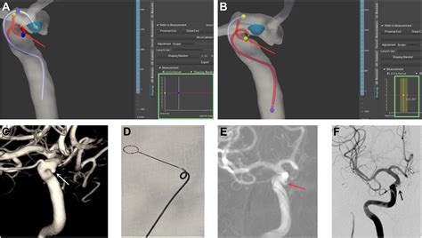 Artificial Intelligence Assisted Microcatheter Shaping For Intracranial