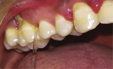 Collection Of Gingival Crevicular Fluid Gcf Using A Calibrated