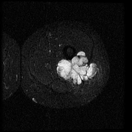 Extraskeletal Chondrosarcoma Radiology Case Radiopaedia Org