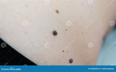 Red Moles And Dots On The Female Body Large Mole On Stomach Melanoma