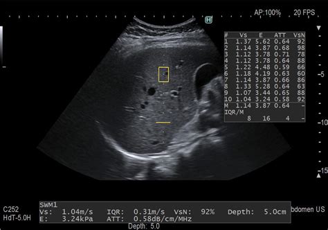 Liver Steatosis Ultrasound