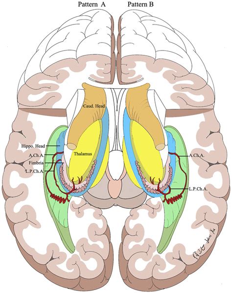 Posterior Choroidal Artery