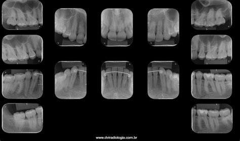 Guia Completo Do Levantamento Periapical DVI Radiologia