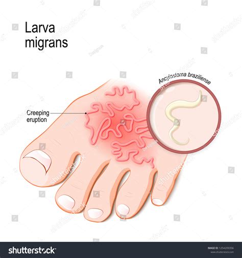 Im Genes De Larva Migrans Im Genes Fotos Y Vectores De Stock