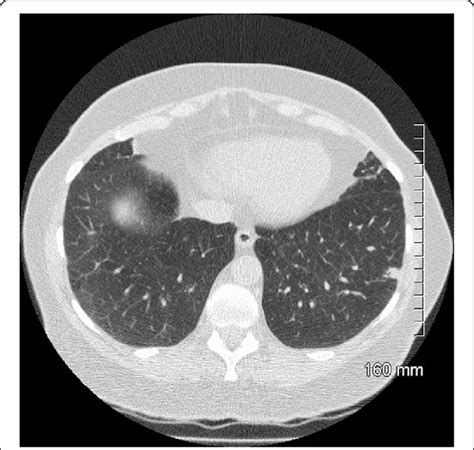 Mia On Ct 9 Mm Part Solid Subpleural Nodule Predominantly Solid In Download Scientific