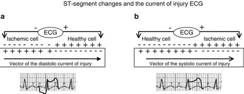 The Electrocardiogram In Ischemic Heart Disease Thoracic Key