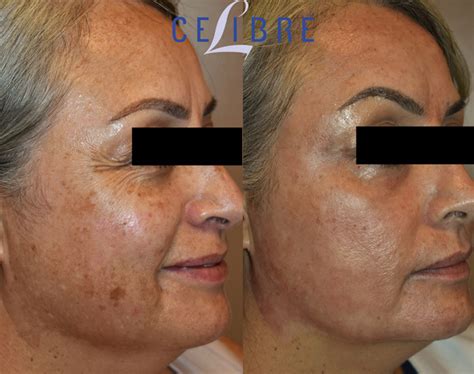 Erbium Laser Resurfacing Uk Store