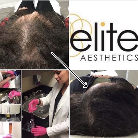 Prp Hair Restoration Michiana Elkhart And South Bend Elite Aesthetics