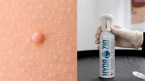 Cryosurgery For Molluscum Contagiosum Hydrozid® Cryosurgery Devices