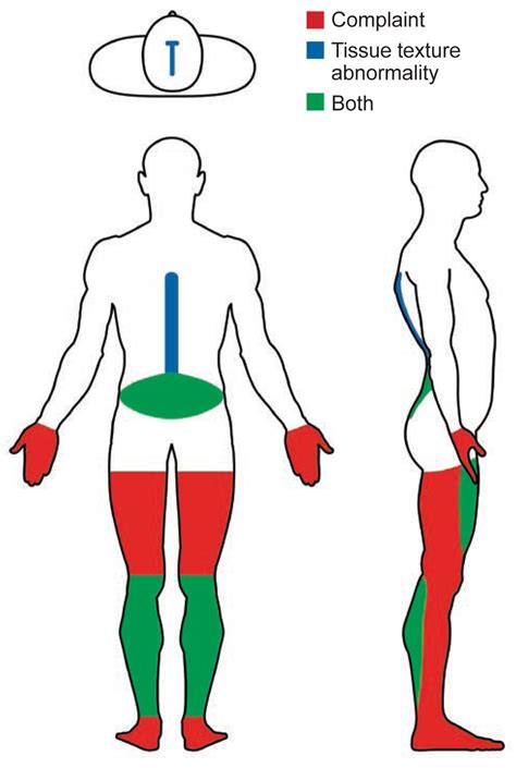 Stiff Person Syndrome Kareenstockard