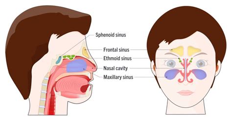 Allergic Sinusitis Allergy And Asthma Consultants Llp Dba Charleston Allergy And Asthma