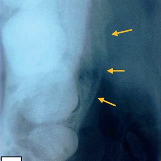 (a) Periapical radiograph revealed a not limited periapical lesion. (b)... | Download Scientific ...