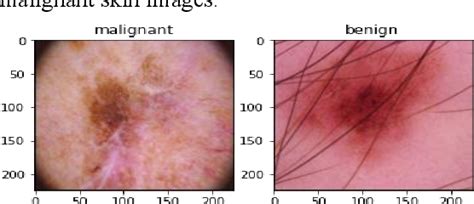 Figure 1 From Early Detection Of Skin Cancer With Mobile Application